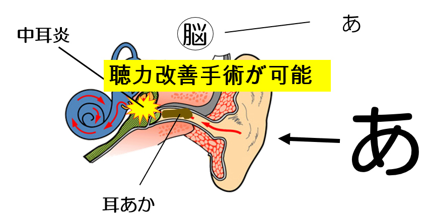 伝音難聴