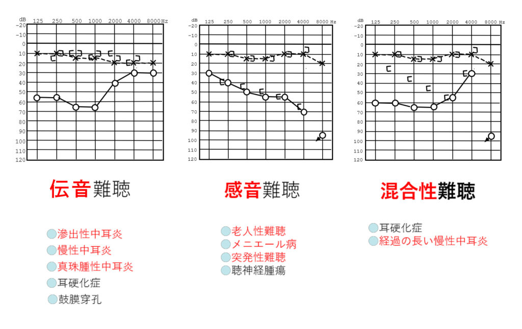 難聴の原因には様々な病態があり、対応法が異なります